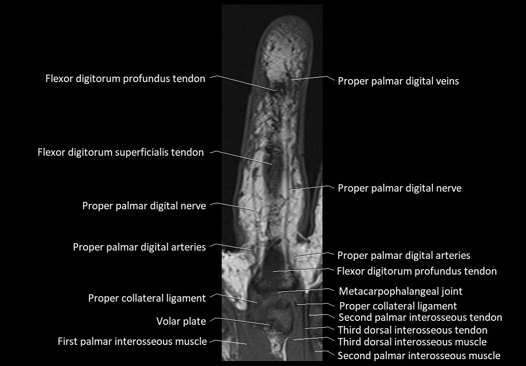 Finger anatomy coronal cross section 3TMRI labelled  image 8.webp